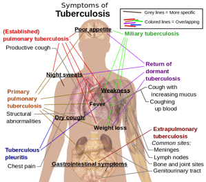 Tuberculosis_symptoms.svg